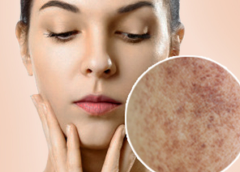 Navigating Macular Amyloidosis Treatment in India - A Comprehensive Guide