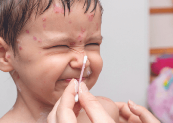 The Difference Between Measles and Chickenpox