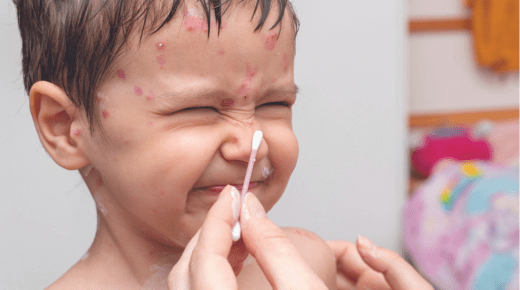 The Difference Between Measles and Chickenpox