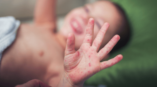 Understanding Chickenpox and Hand, Foot, and Mouth Disease