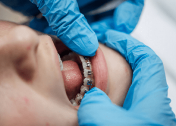 Why Some Grownups Need Braces or Aligners