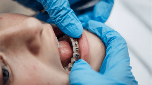 Why Some Grownups Need Braces or Aligners