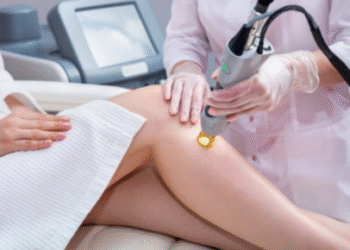laser hair removal treatment