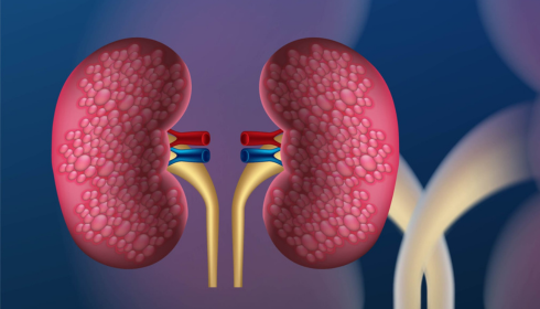 kidney stone treatment