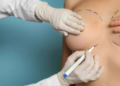 Breast Augmentation In Bangalore