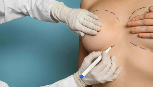 Breast Augmentation In Bangalore